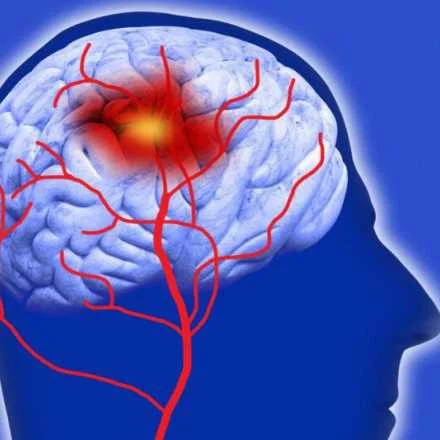 unnamed (33) Illustration of stroke in brain