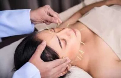 acu-400×257 acupuncture needles in face